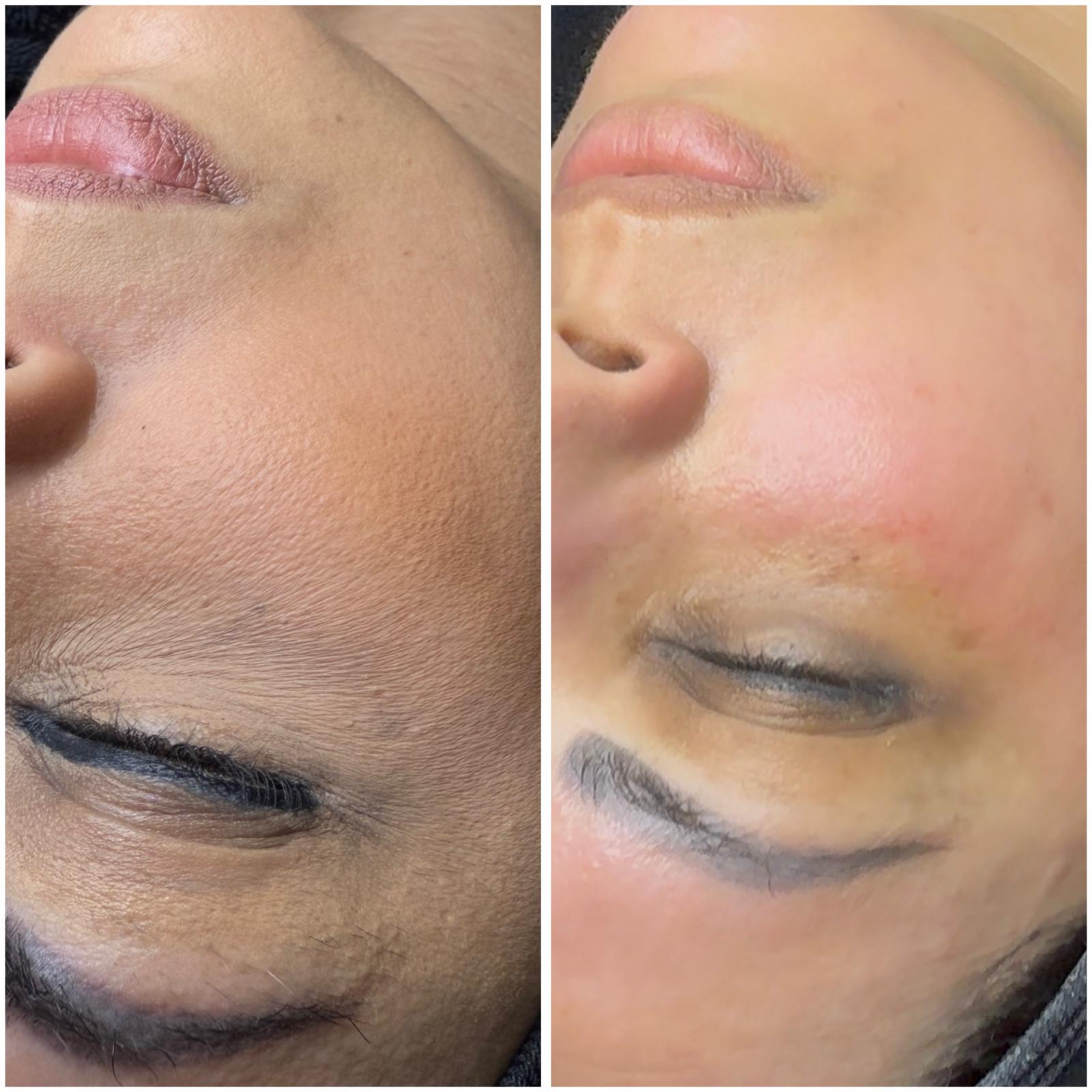 Basic Facial Treatment