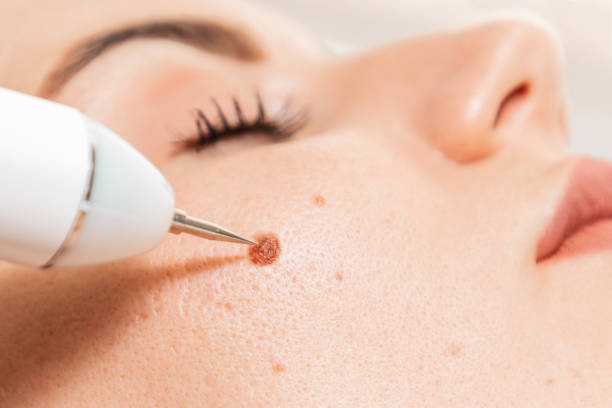 Beauty Spot Removal
