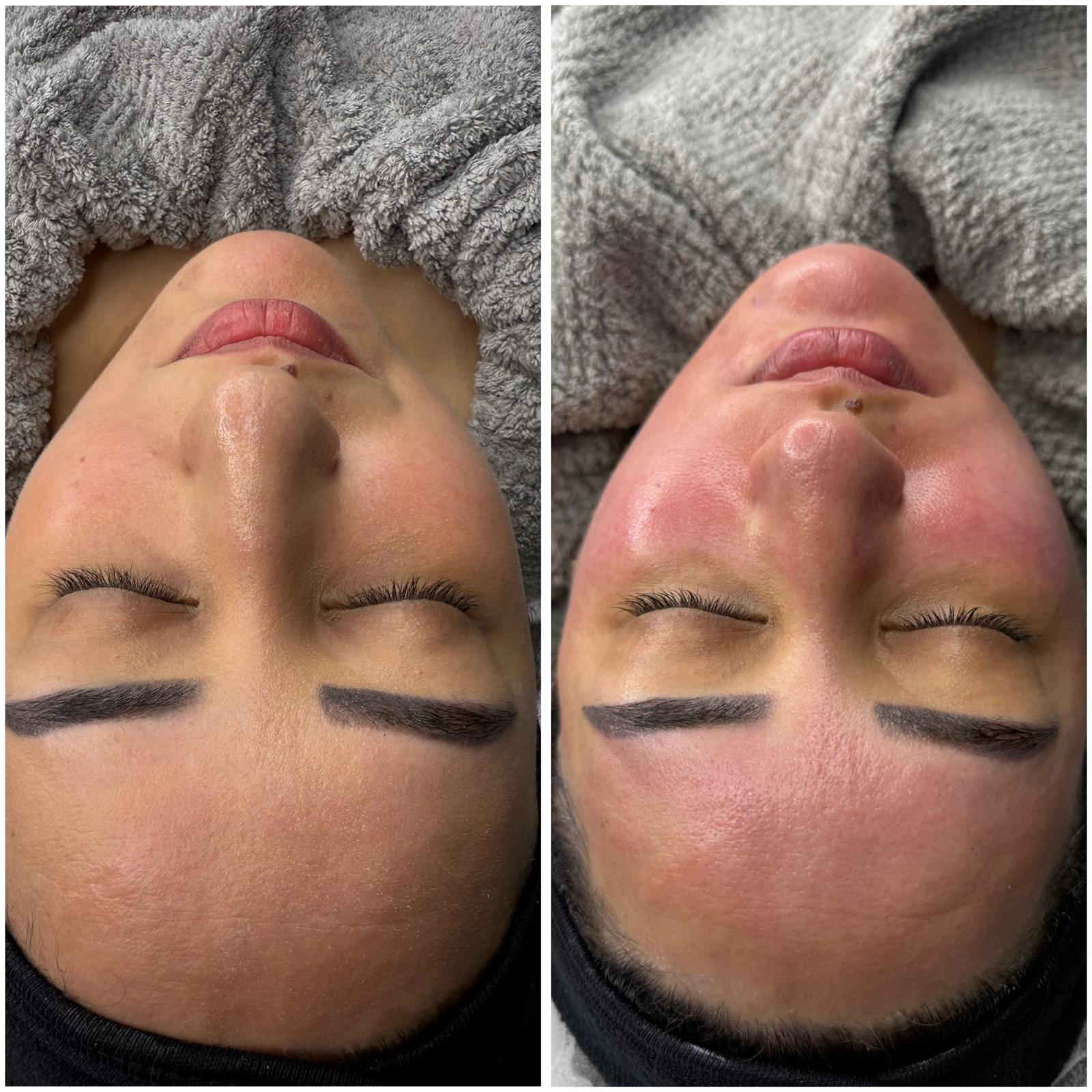 Hydrafacial