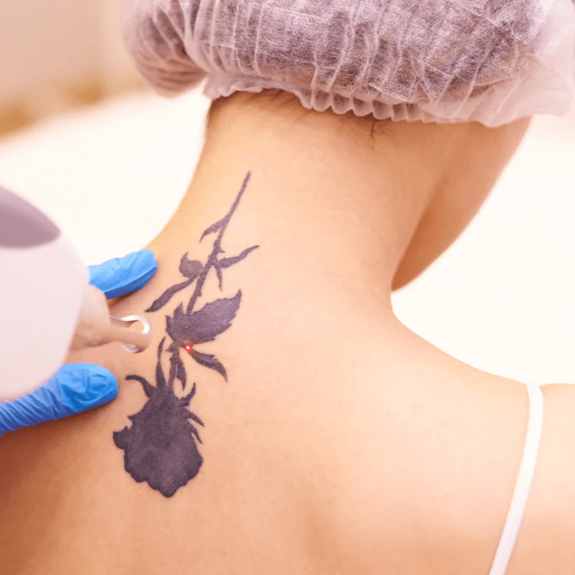 Tattoo Body Removal